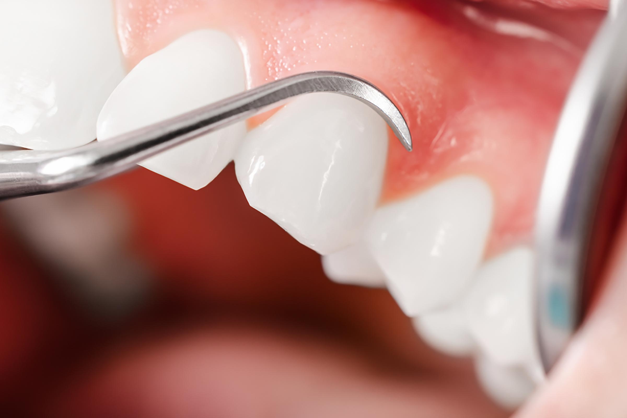 Diş Eti Tedavileri (Periodontoloji)